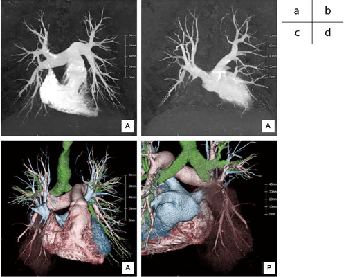 ダイナミックヘリカルスキャンを使用した肺動静脈分離撮影