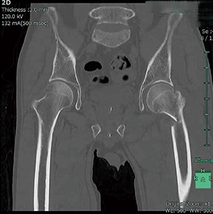 MPR画像により、転子部骨折の部位や範囲を正確に把握することができる。