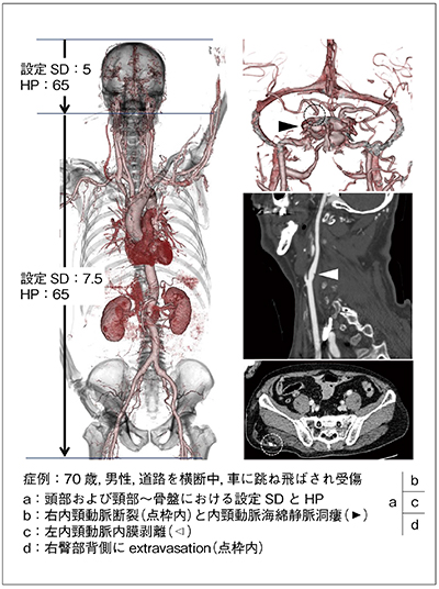 バリアブルピッチヘリカルスキャンを用いた外傷全身CTの症例画像