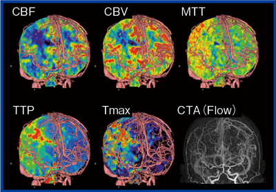 図2　右内頸動脈閉塞症例のDynamic CT画像
