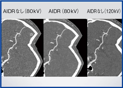 図6　AIDR 3Dの有無による頭部CTA（curved MPR）の比較