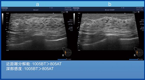 図7　正常乳腺におけるPLT-805AT （a：9MHz）とPLT-1005BT（b：14MHz）の比較