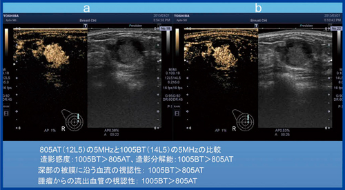 図11　症例5：囊胞内腫瘤（乳管内乳頭腫） PLT-805AT（a：5MHz）とPLT-1005BT（b：5MHz）の比較