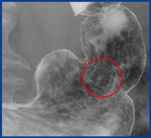 図1　‌X線検査の追加撮影により診断された高分化管状腺がん