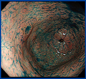 図2　‌インジゴカルミン色素を散布した内視鏡画像
