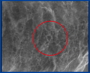 図4　‌微小胃がん（4mm×3mm，未分化型）のX線画像