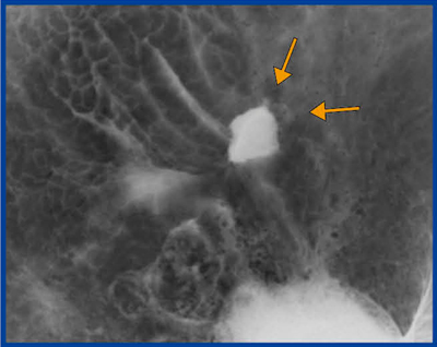 図6　‌図5に加えて追加撮影したX線画像 ただの良性腫瘍ではない，悪性・悪性疑い