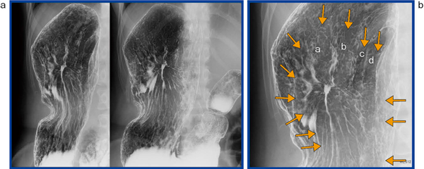 図8　‌linitis plastica型（Latent LP）胃がんにおけるX線画像のひだ所見