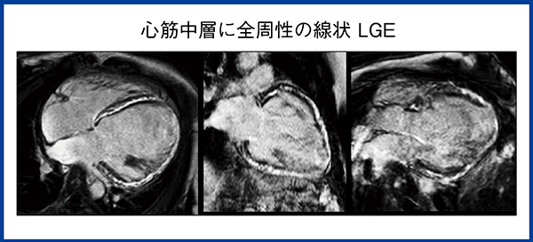 図3　拡張型心筋症（DCM）の遅延造影MRI画像（LGE MRI）