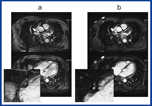 図6　新開発冠動脈MRAシーケンスと従来型の比較