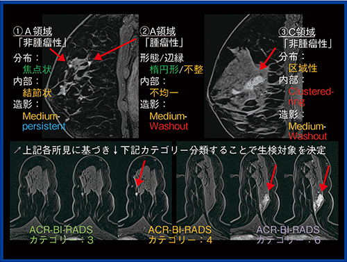 図2　47歳，女性，左乳房（BPE：minimal）の各病変の所見とカテゴリー分類