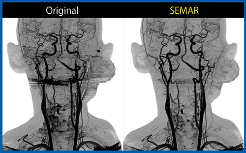 図8　症例5：下顎の骨肉腫術後再発における動注治療前のSEMAR併用サブトラクション3D CTA
