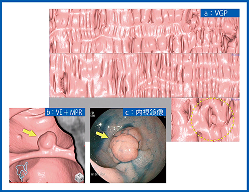 図2　症例2：10mm大のⅠsp型（隆起型・亜有茎型）大腸腺腫