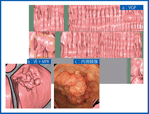 図4　症例4：50mm大のⅡa型（表面隆起型）大腸腺腫