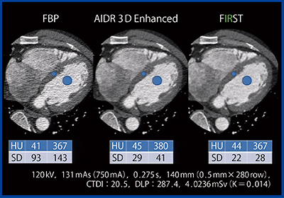 図3　症例2の心筋と心内腔におけるSDの比較