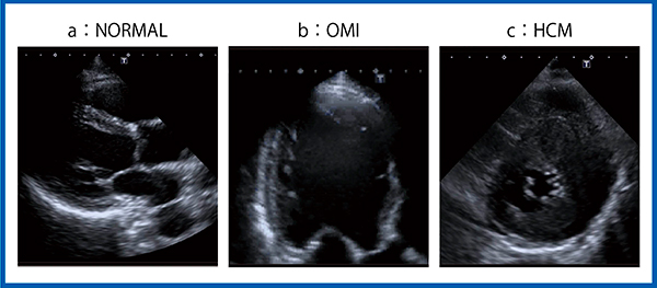 図9　Aplio iシリーズによる正常例（a），陳旧性心筋梗塞（b），肥大型心筋症（c）の画像