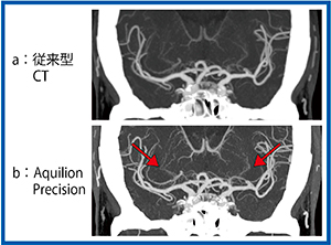 図3　中大脳動脈穿通枝，レンズ核線条体動脈比較画像