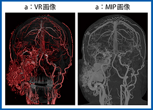 図6　Aquilion Precisionによる顔の動静脈奇形に血管腫が合併した症例の画像