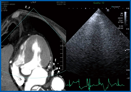 図2　症例：Fusion Imagingによる術前CT画像と術中超音波画像の同期表示