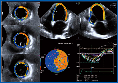 図3　下壁心筋梗塞症例における3D-WMTによる局所壁運動評価