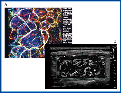 図10　SMIによる濾胞性腫瘍の描出 a：共焦点レーザー顕微鏡像＊　b：mSMI （＊伊藤病院・佐々木栄司氏提供）