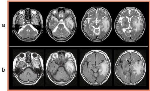 図3　症例の頭部MRI画像 a：T2強調画像 b：FLAIR