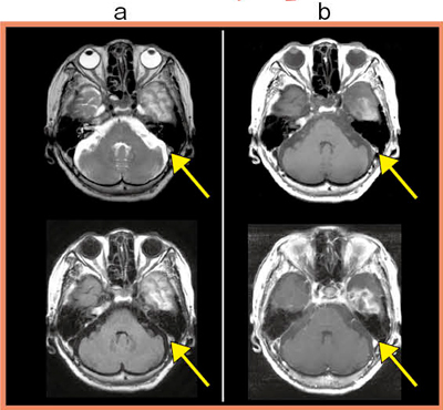 図4　症例の頭部MRI画像 a：左の横静脈洞からS状静脈洞にかけ，flow voidが消失している（←）。 b：造影後T1強調画像では，S状静脈洞に増強欠損域は認められない（←）。