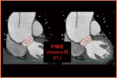 図7　症例5：斜冠状断での弁輪径，Valsalva洞，sino-tubular junction（STJ）の測定