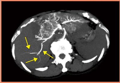 図3　4D-CTによる大腸がん肝転移症例の動注リザ―バー療法でのフローチェック 背側側に向かう血管の血流が押し戻されている様子が描出された（→）。