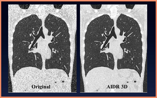 図1　AIDR 3Dによる低線量CT