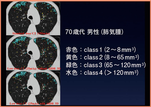 図6　COPDにおける機能画像評価2）