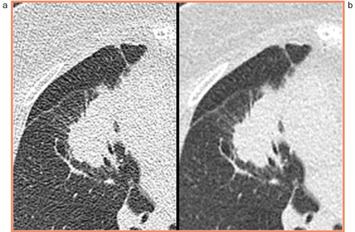 図1　60mA（21mAs）で撮影された肺腫瘍の画像 a：AIDR 3Dなし，b：AIDR 3Dあり