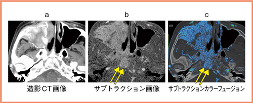 図2　Case2：上顎洞腺様囊胞がん頭蓋底浸潤