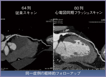 図2　64列CTと80列Aquilion PRIMEの画像の比較