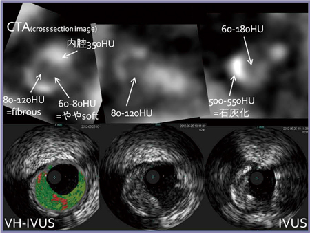 図5　症例2：CT値によるプラークの性状評価（上段）とIVUS画像（下段）