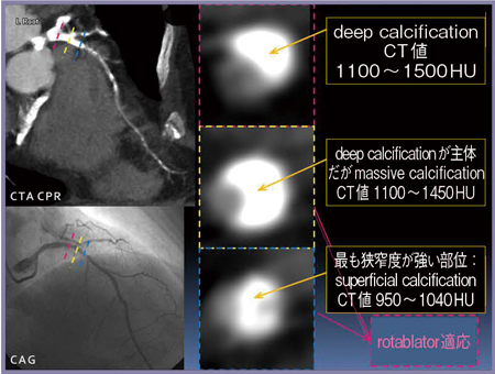 図6　症例3：CTAによる石灰化評価