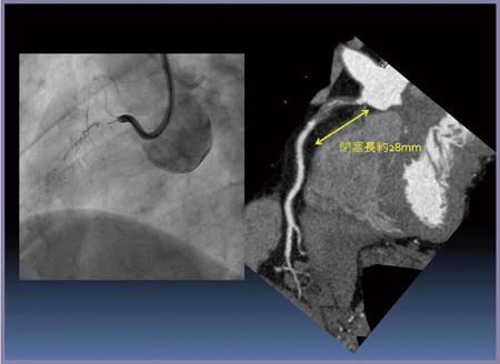 図7　症例4：CTAのCPRによる側副血管の確認 血管造影（左）では末梢が描出されず閉塞長も不明。 真腔か側副血管か判別できない。