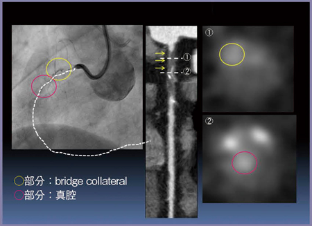 図8　症例4：CTAによる真腔と側副血管の判定（CTO RCA ♯1）