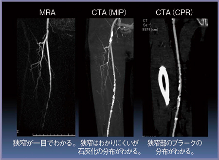 図10　MRAとCTAの比較