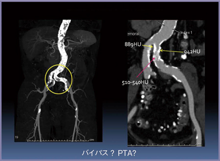 図11　症例5：PTA術前の石灰化の評価 （左CIA石灰化病変）