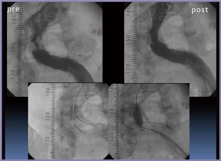 図12　症例6：PTA術前（左）・術後（右）のCAG
