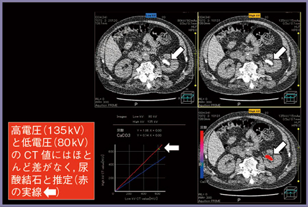 図3　症例1：Dual Energy Scanの解析結果
