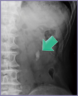 図4　症例2：腹部単純X線画像 明瞭に描出される左腎杯結石（←）