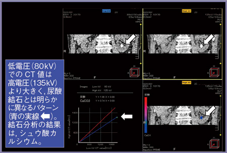 図5　症例2：Dual Energy Scan解析結果