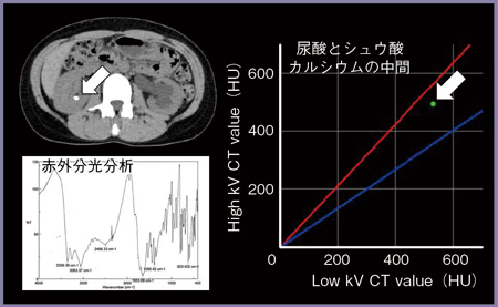 図12　DHA結石のDual Energy 解析結果