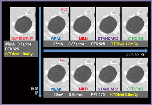 図4　AIDR 3D使用による画質変化