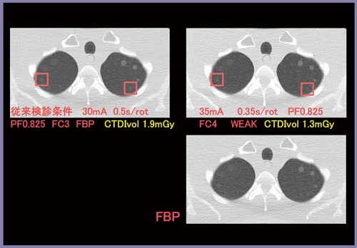 図5　画質優先での検討結果 従来検診画像より管球回転速度UP。AIDR 3D WEAK使用によりストリークアーチファクトとノイズが低減している。
