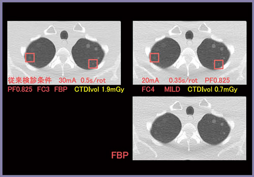 図6　検出能優先での検討結果 Δ270HU 4mm および Δ100HU 8mm検出は可能だが，信号の辺縁はFBPより劣る。