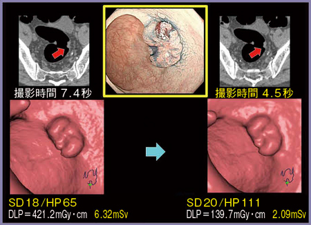 図1　症例1： HP111での大腸CT 撮影時間を4.5秒に短縮可能