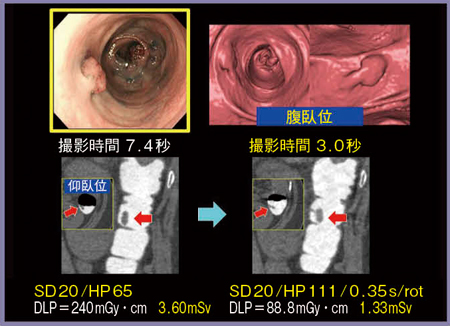 図2　症例2：HP111と0.35s/rotの併用 撮影時間は約3秒